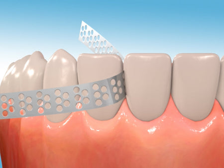 What is Interproximal Reduction (IPR) and Why Do You Need It?