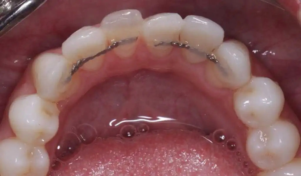 Retainers vs. fixed wires.